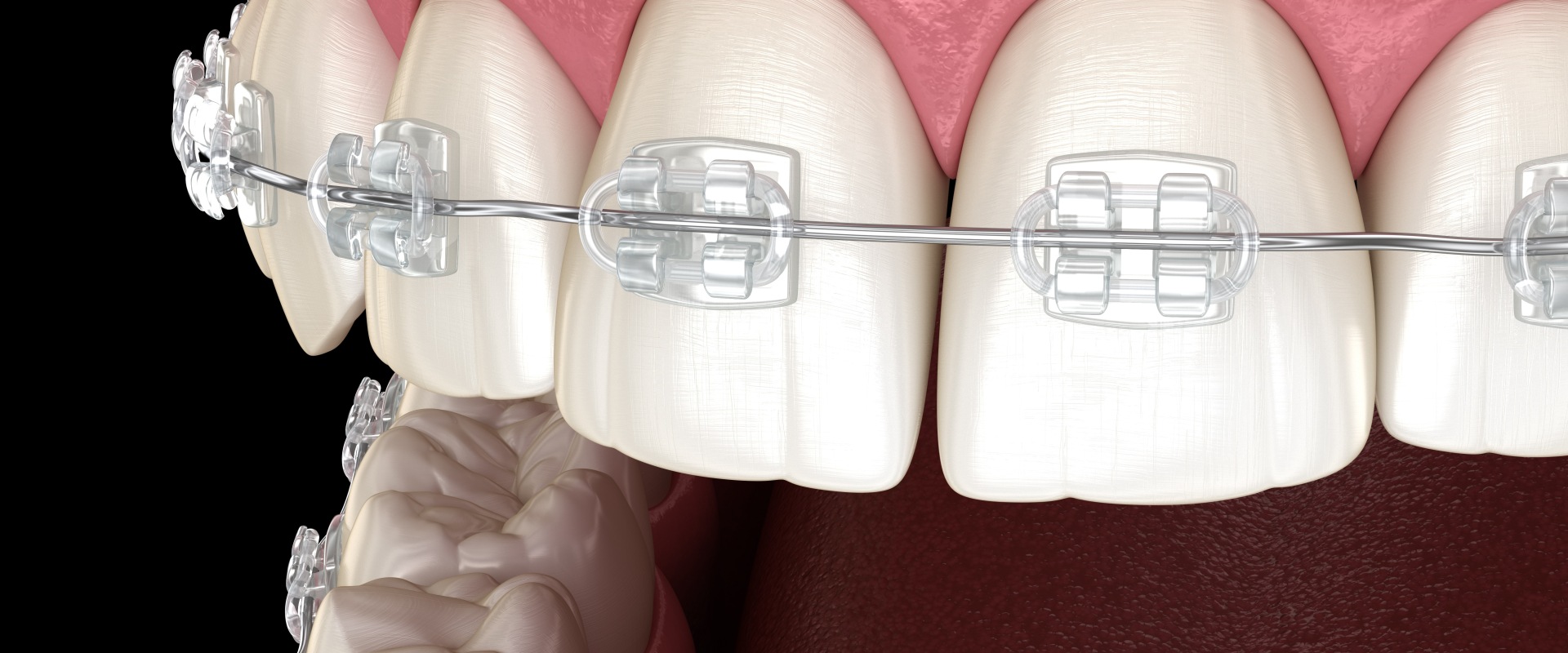 Are cosmetic braces real?