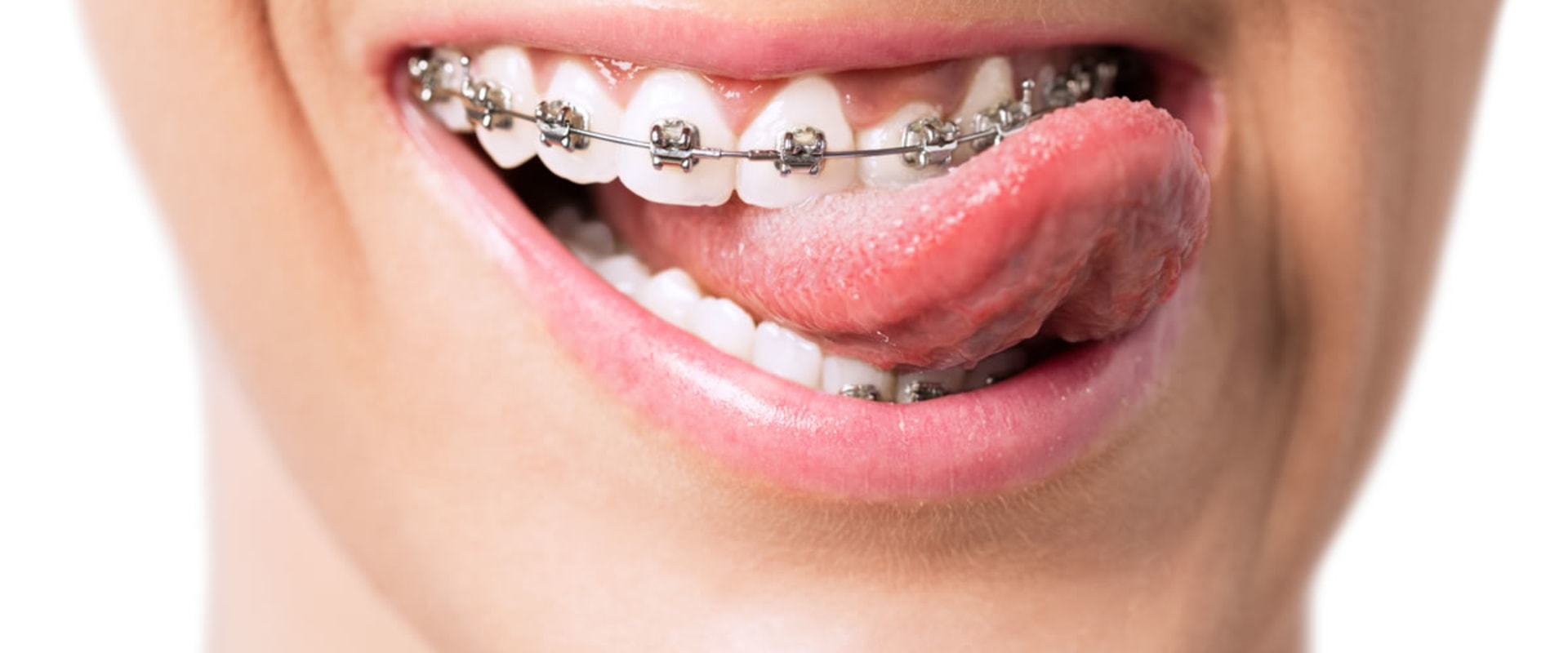 What is orthodontia used for?