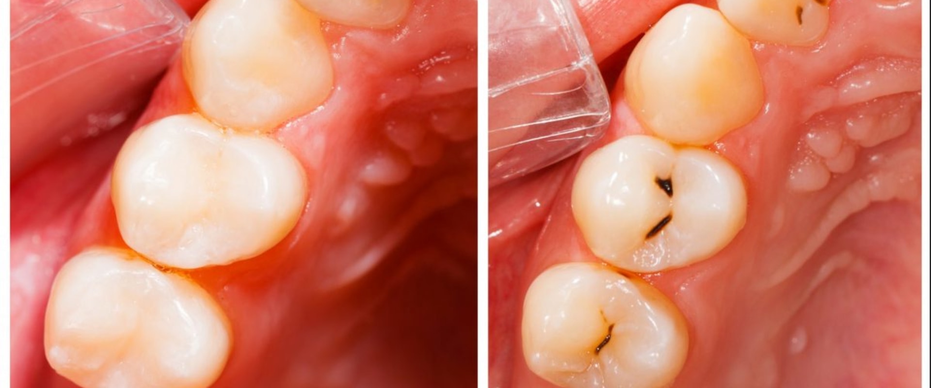 Are fillings considered restorations?