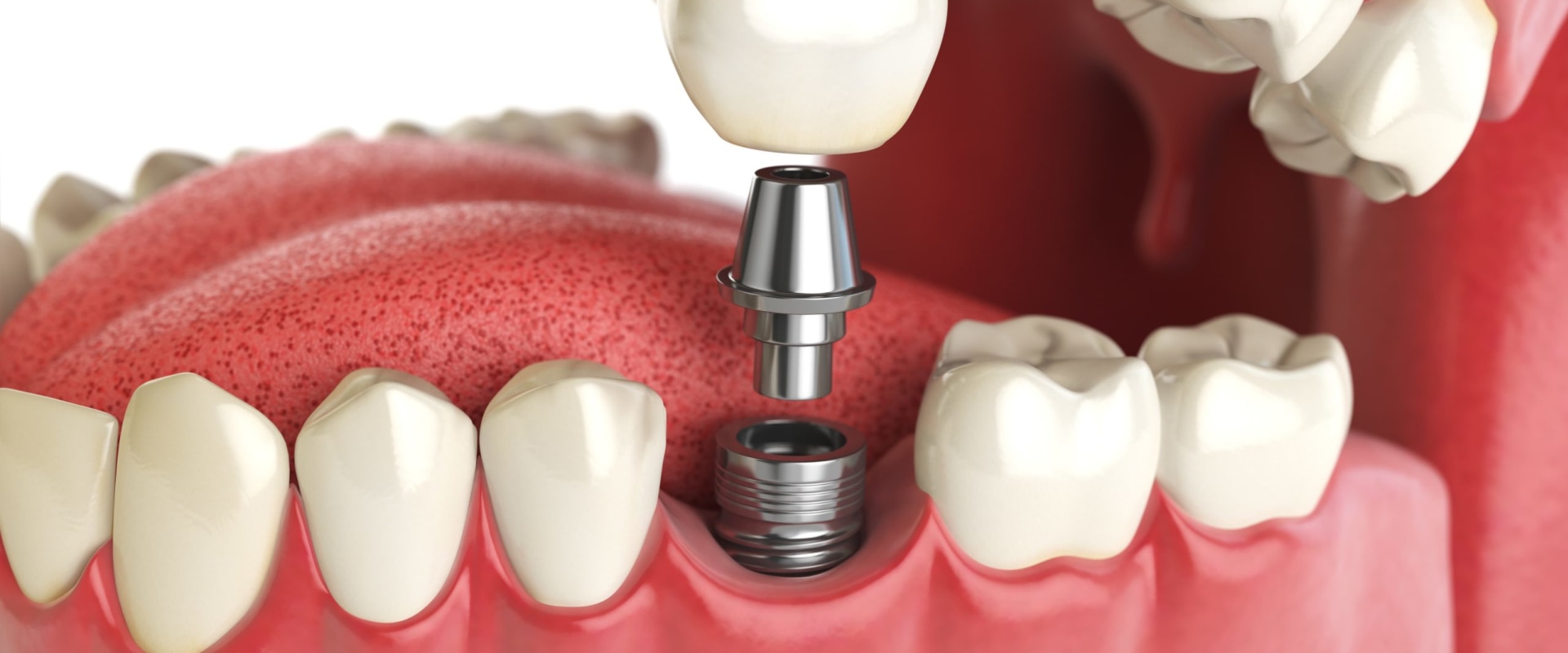 Austin General Dentistry: The Benefits Of Getting Implants From An Experienced General Dentist