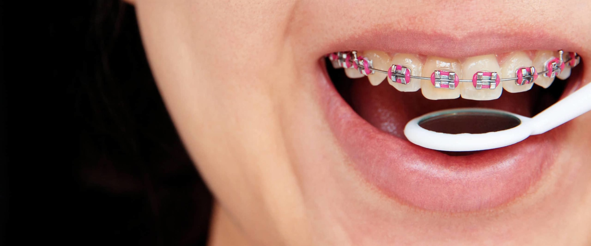 What are the types of orthodontic treatment?