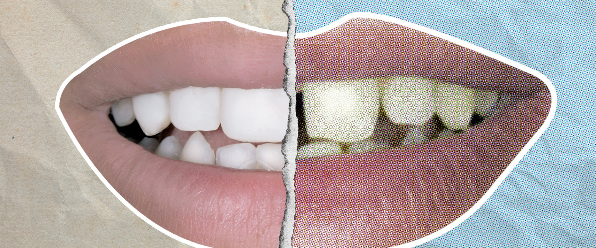 How much does it cost to get your teeth done like celebrities?