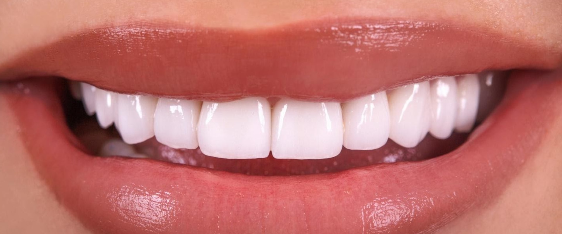 General Dentistry: What You Need To Know About Dental Veneers In London