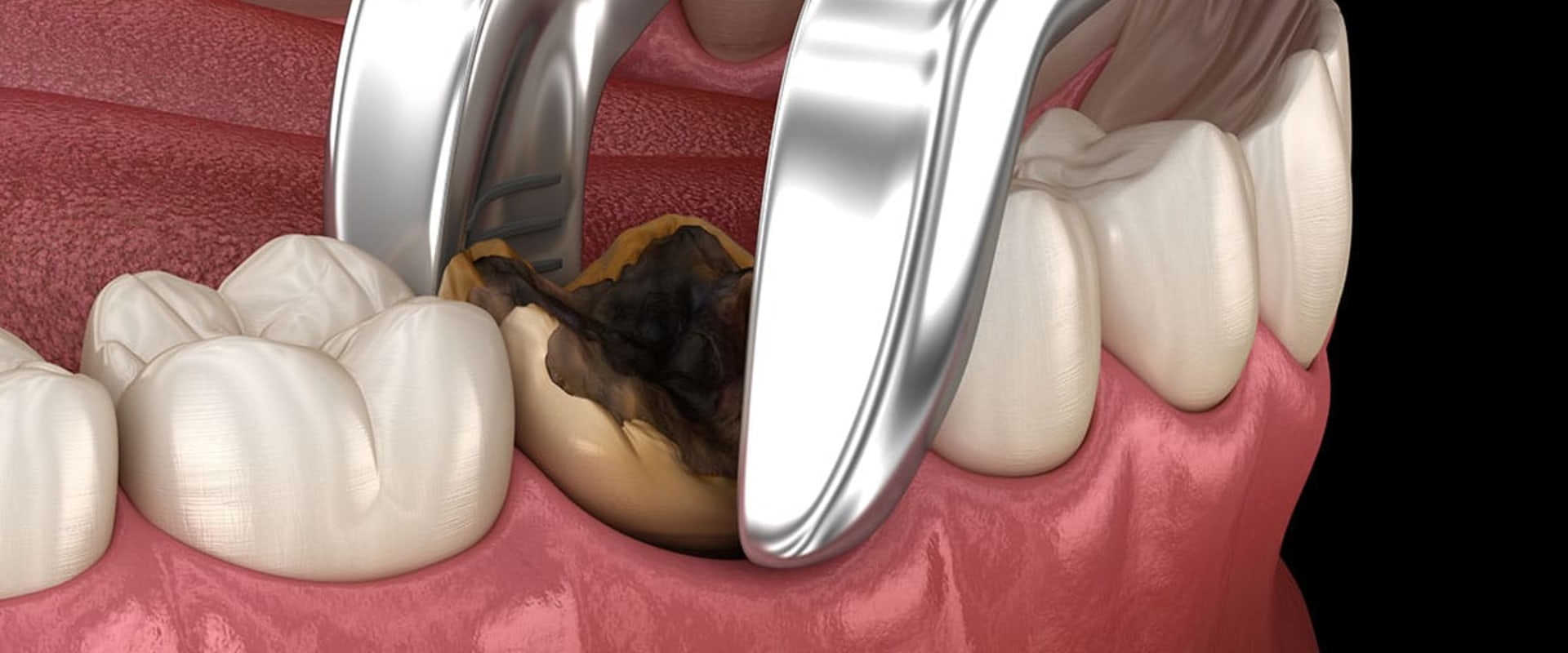 What is the most complicated dental procedure?
