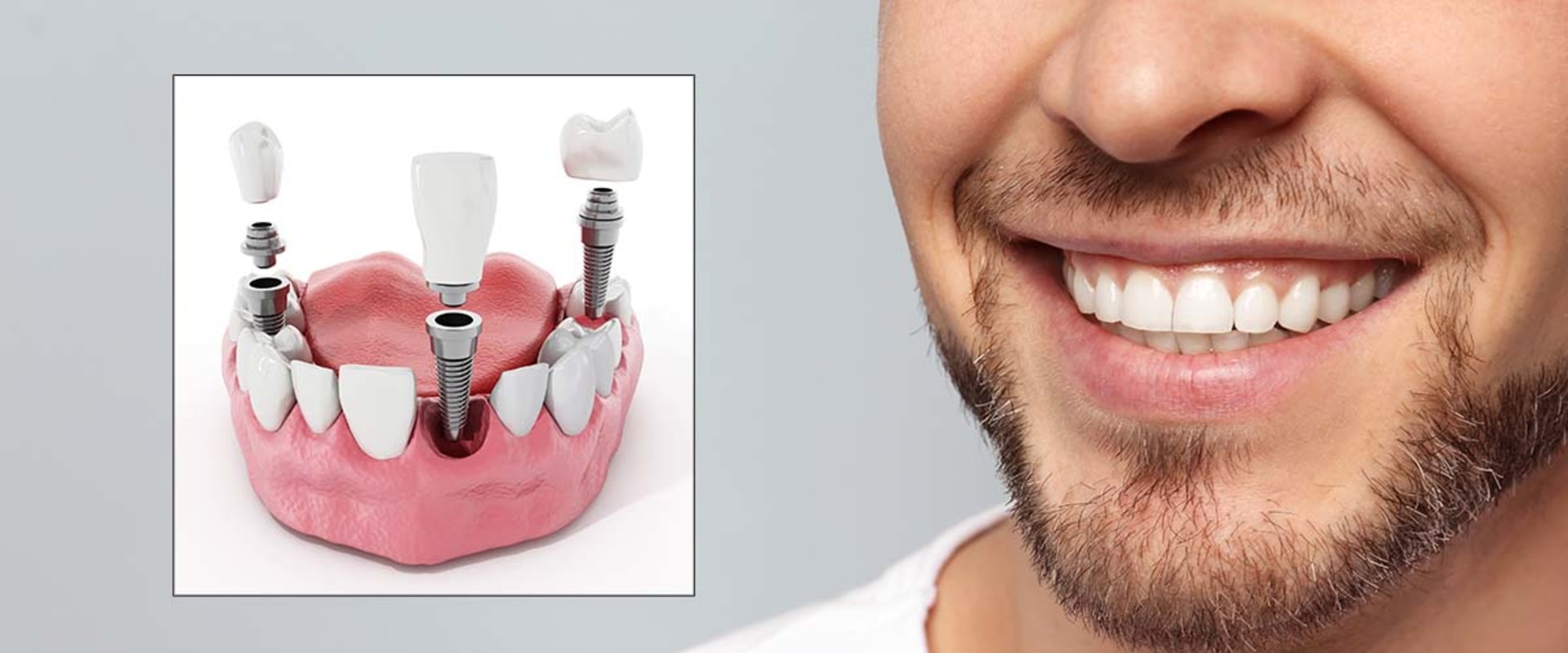 General Dentistry: All You Need To Know About Dental Implants In Beverly Hills, CA