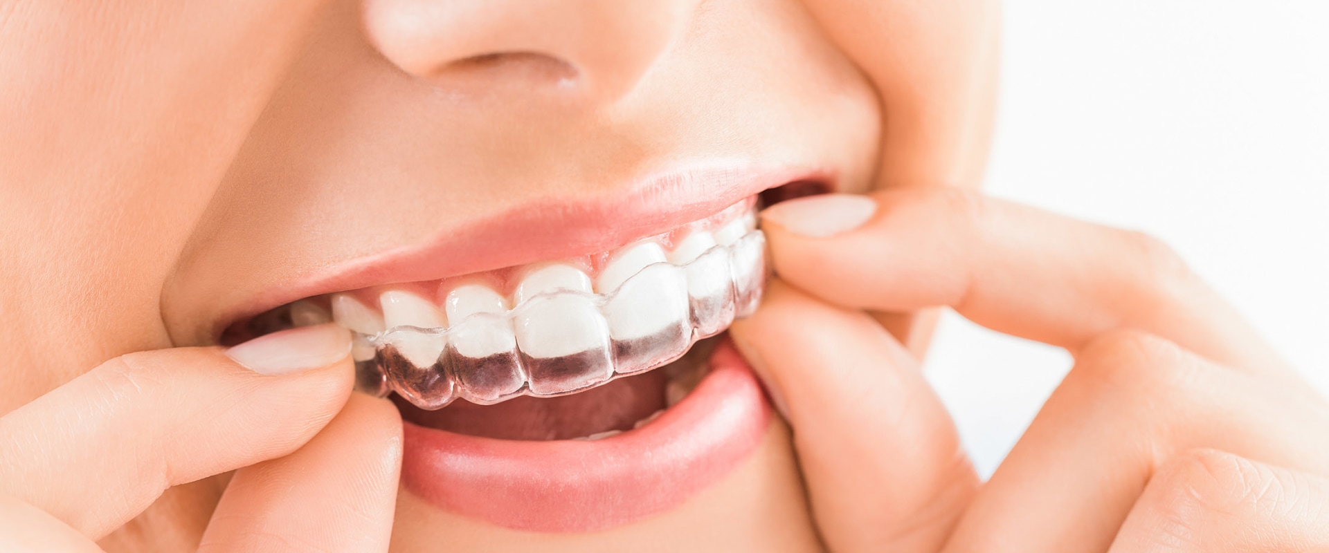 Invisalign: The New Trend In General Dentistry In Texas