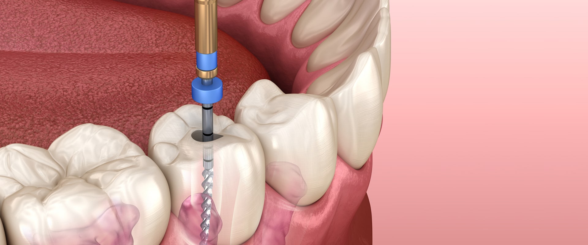 Does general dentistry include root canals?