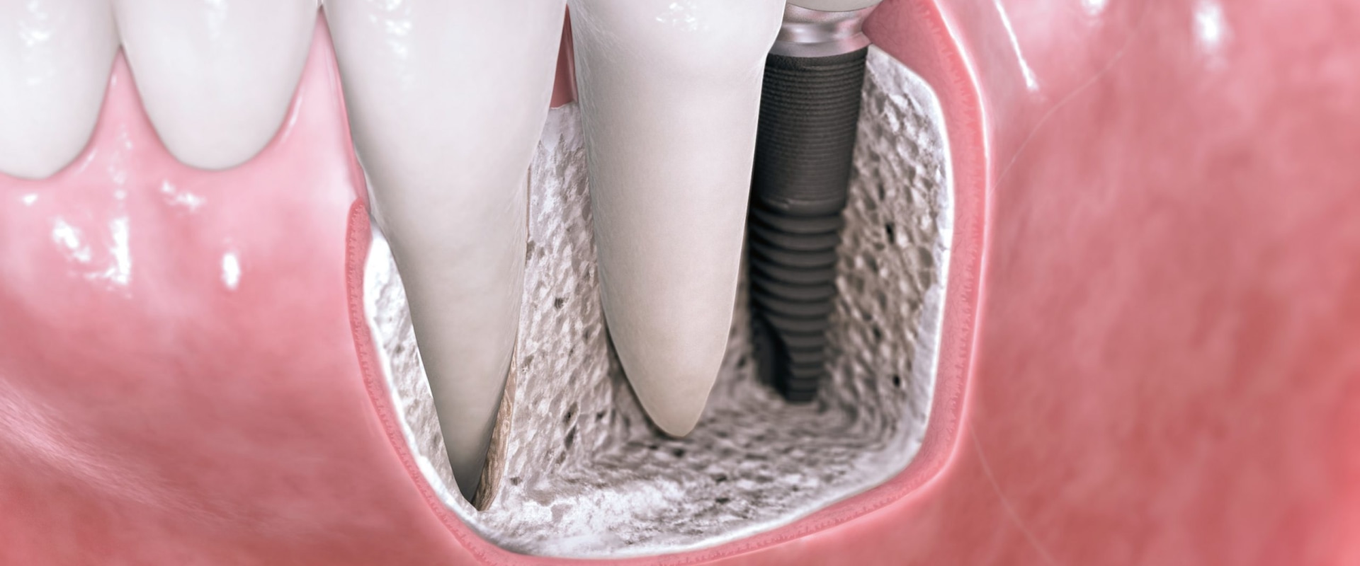 Does general dentistry include implants?