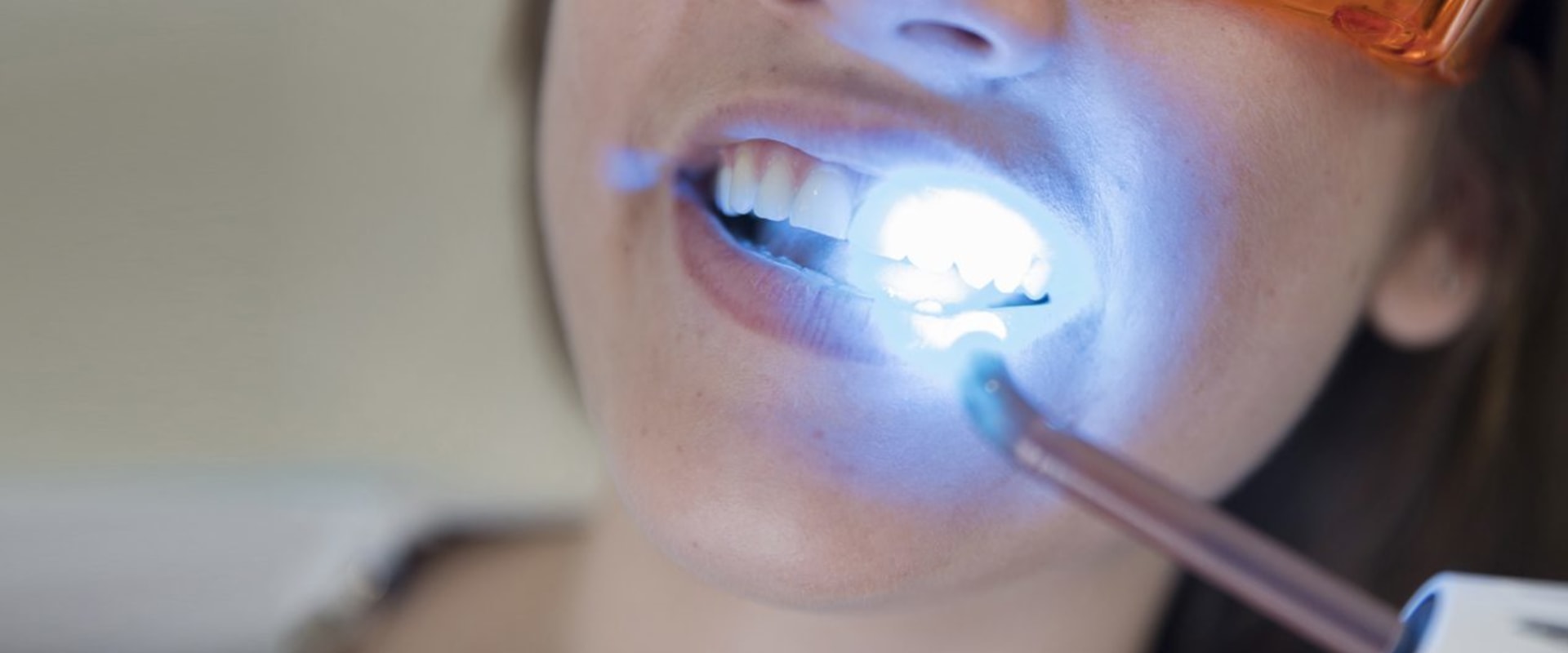 Teeth Whitening In Austin: The Perfect Choice For A Beautiful Smile