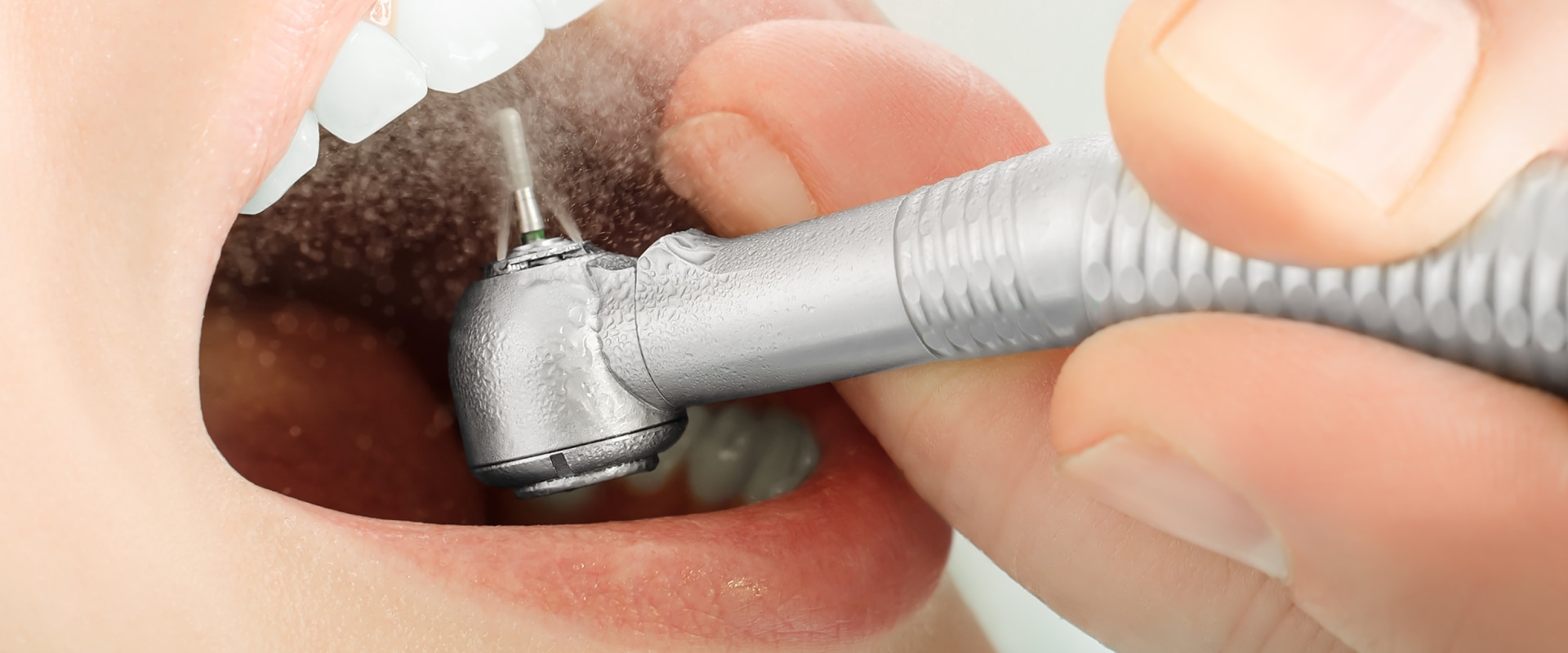 How many types of dental restoration are there?
