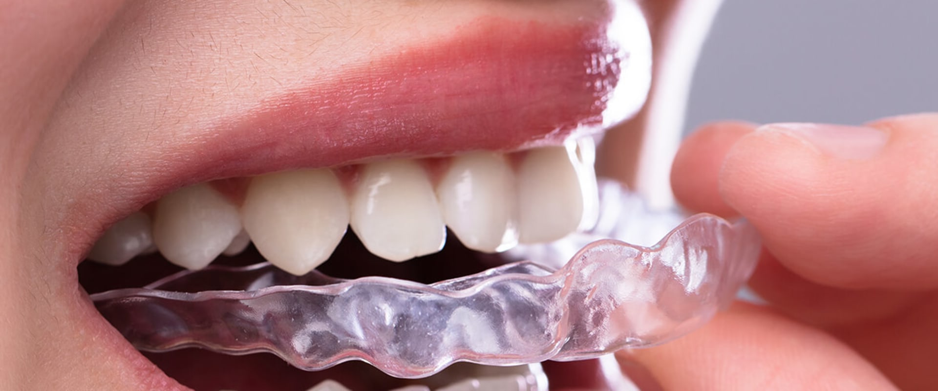 Why Invisalign Is A Great Option For General Dentistry Patients In Austin?