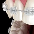 Are cosmetic braces real?
