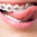 What is orthodontia used for?