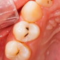 Are fillings considered restorations?