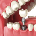 Austin General Dentistry: The Benefits Of Getting Implants From An Experienced General Dentist