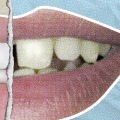How much does it cost to get your teeth done like celebrities?