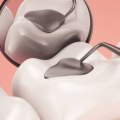 What type of service is fillings?
