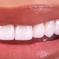 General Dentistry: What You Need To Know About Dental Veneers In London