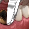 What is the most complicated dental procedure?