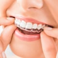 Invisalign: The New Trend In General Dentistry In Texas