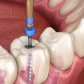 Does general dentistry include root canals?