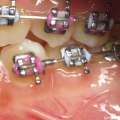 What is phase 3 orthodontic treatment?