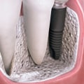 Does general dentistry include implants?