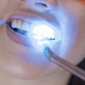Teeth Whitening In Austin: The Perfect Choice For A Beautiful Smile