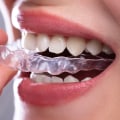 Why Invisalign Is A Great Option For General Dentistry Patients In Austin?
