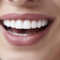 What is the best way to get perfect teeth?
