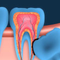 Will a general dentist remove wisdom teeth?