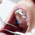 General Dentistry In Spring Branch: How To Properly Care For Your Teeth