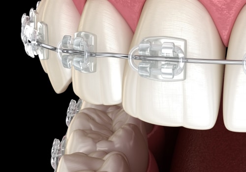 Are cosmetic braces real?