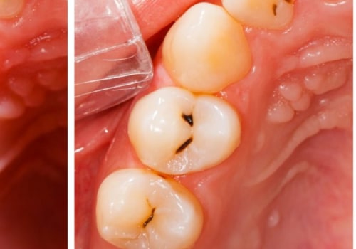 Are fillings considered restorations?