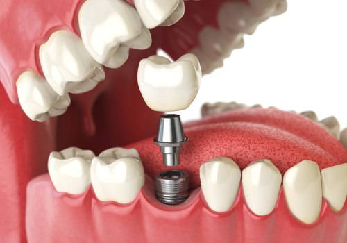 Austin General Dentistry: The Benefits Of Getting Implants From An Experienced General Dentist
