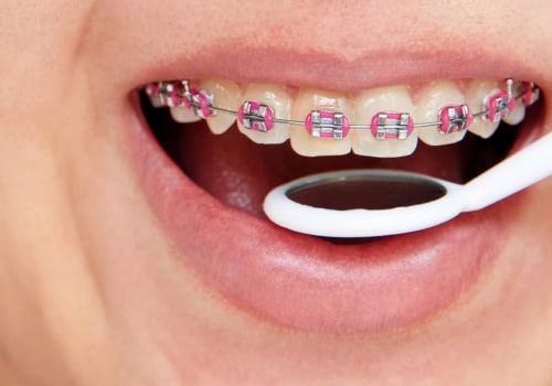 What are the types of orthodontic treatment?