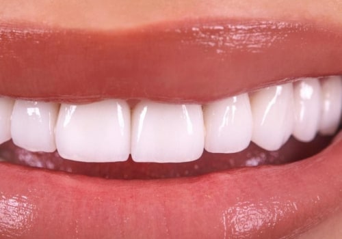 General Dentistry: What You Need To Know About Dental Veneers In London