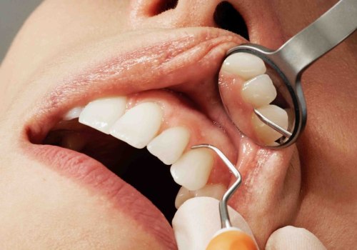 What is the most common cosmetic dental procedure?