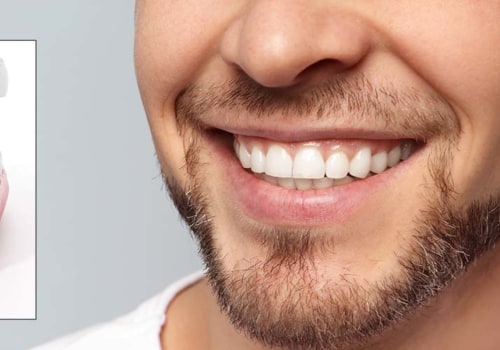 General Dentistry: All You Need To Know About Dental Implants In Beverly Hills, CA