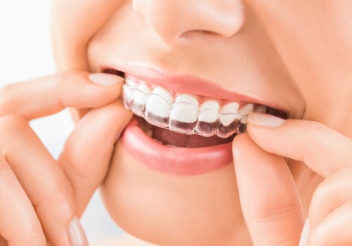 Invisalign: The New Trend In General Dentistry In Texas