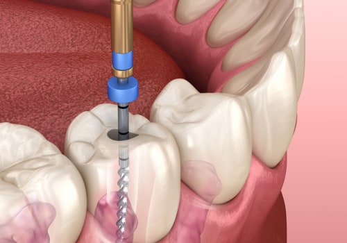 Does general dentistry include root canals?