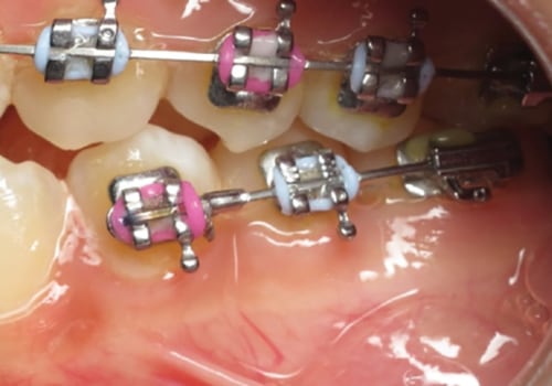 What is phase 3 orthodontic treatment?