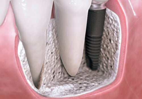 Does general dentistry include implants?