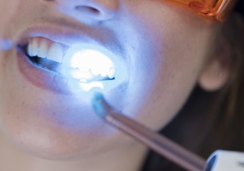 Teeth Whitening In Austin: The Perfect Choice For A Beautiful Smile