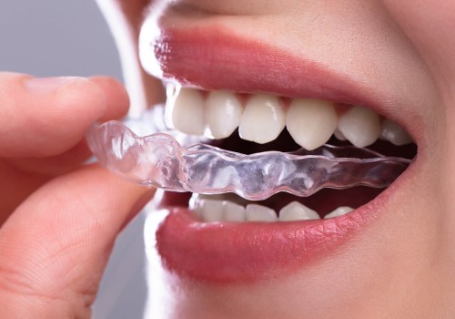 Why Invisalign Is A Great Option For General Dentistry Patients In Austin?