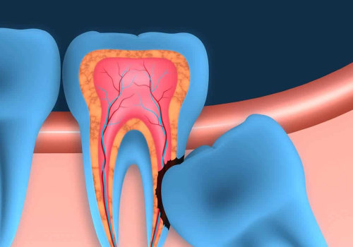 Will a general dentist remove wisdom teeth?