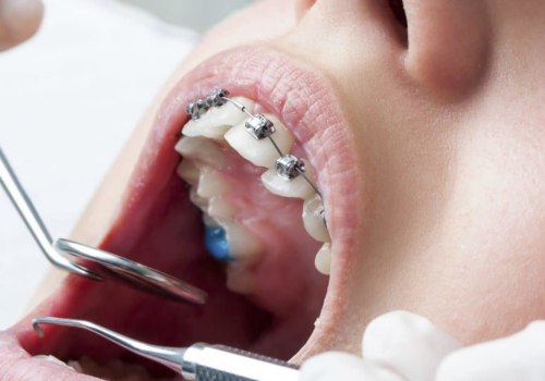 General Dentistry In Spring Branch: How To Properly Care For Your Teeth